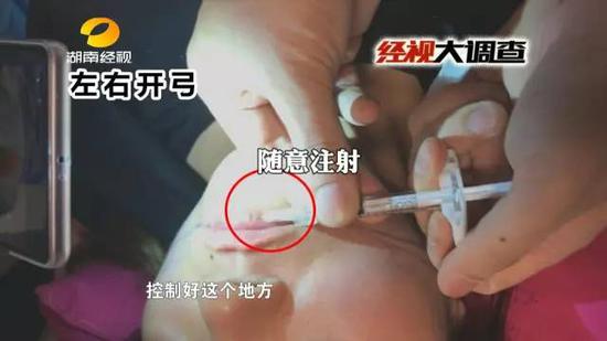 随意的消毒后,这位老师连消毒手套都没有戴,就开始在模特的嘴唇上注射,实操模特疼得哭出声来。