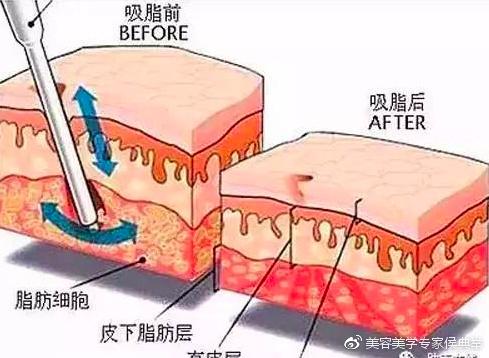 腰腹吸脂过程