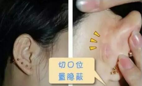 耳朵的软骨居然可以做鼻子整形?|隆鼻|软骨|自体_新浪女性_新浪网