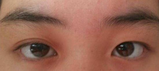 【长沙雅美】眼睛一单一双怎么办?_第1页_整形美容项目_都市_西祠胡同