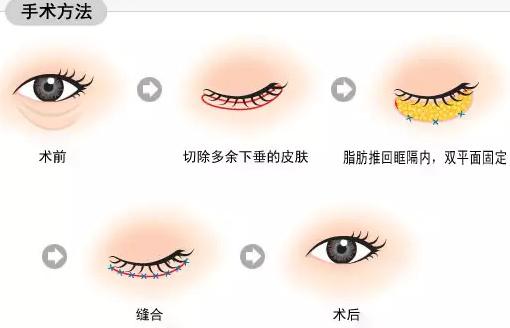 国庆长假想整形?小心眼部整形的十大误区!|眼