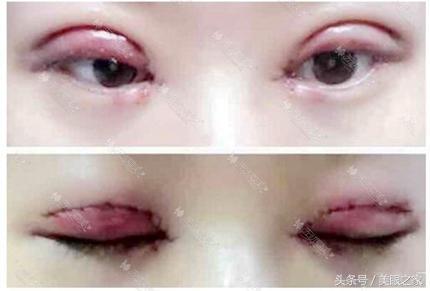 2017年整形失败四大天亡割眼袋居首!