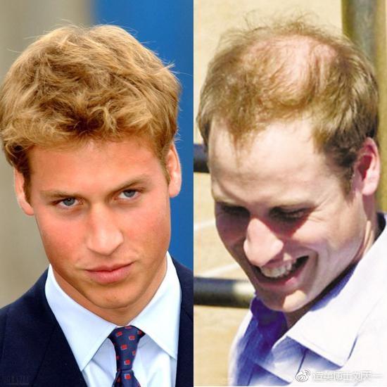　　有头发和没头发完全是两个水平的颜值的威廉王子