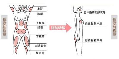 脂肪移植术后护理大全|塑身衣|手术|脂肪_新浪女性_新浪网