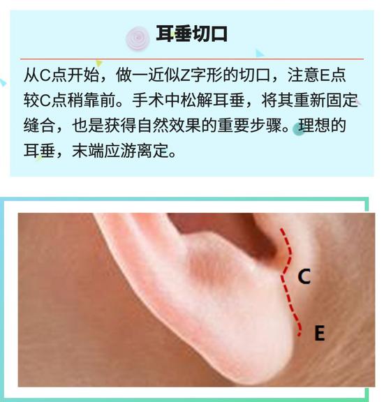 耳垂切口