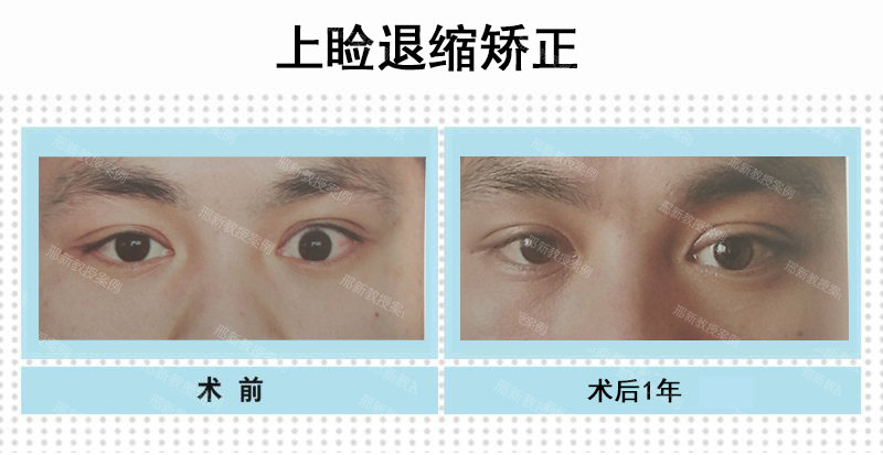 术前瘢痕性左上睑退缩，术前正位睁眼状态（图左）术后一年正位睁眼状态，左侧上睑位置恢复正常，两侧睑裂基本对称（图右）