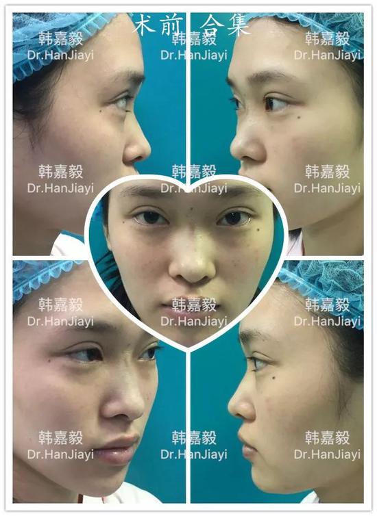 近视镜鼻子塌陷怎么改善,近视镜鼻子塌陷怎么改善视频
