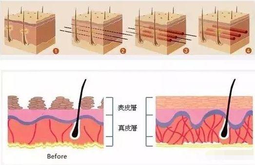 进阶式