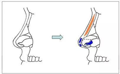 假体隆鼻