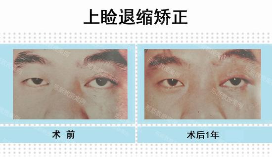 左上睑外伤后癞痕性上睑退缩（图左）术后一年正位睁眼状态（图右）