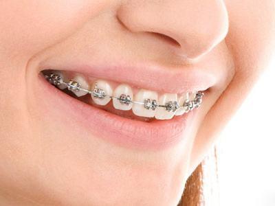 牙齿矫正后会不会反弹