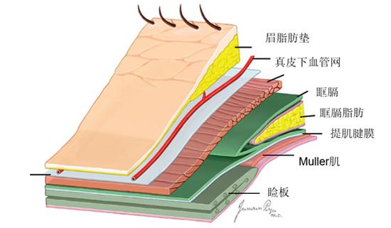 图5  上睑解剖示意图 图中可见袋状的眶隔被眶隔前后壁包裹