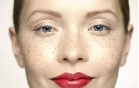 真皮斑根深蒂固 怎么祛除