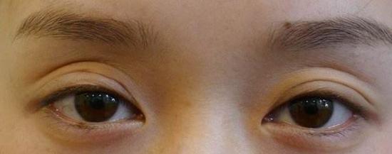 内双做双眼皮会成三眼皮 多半是因为医生手术