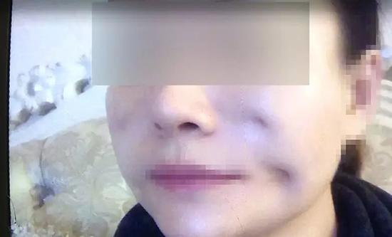 女子脸整容整出8个坑 整形医院这样回应令当事人无法接受