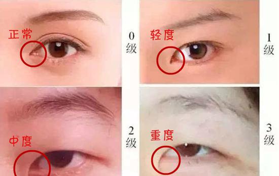 眼睛1.0-是多少度,眼睛10是多少度近视