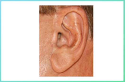 图1 耳前直线瘢痕