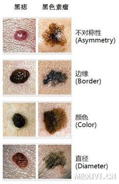 痣与“痦子”的区别示意图