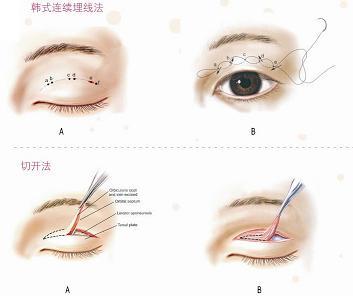 双眼皮手术