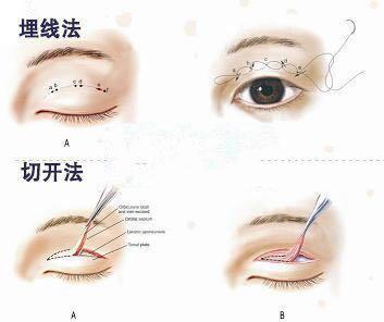 双眼皮