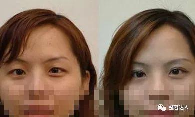 恢复期短