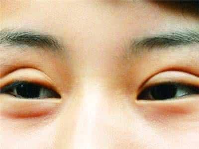 双眼皮失败修复手术的原则