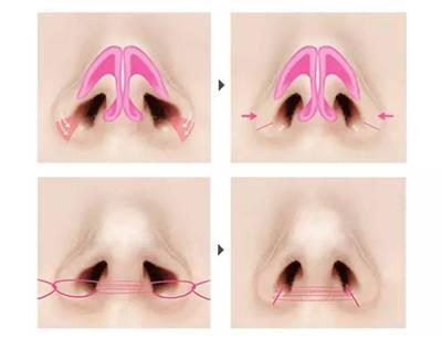 鼻翼缩小术后疼痛怎么办?|鼻孔|手术|鼻子