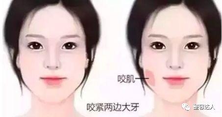 四点分清溶脂针和瘦脸针两者对应的症状有哪些