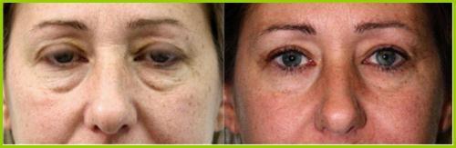 激光溶脂收紧眼袋治疗前与治疗后3个月对比图片
