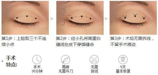 埋线双眼皮手术
