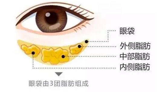 专业眼袋整形手术 方法选择很重要!