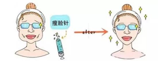 咬肌发达型