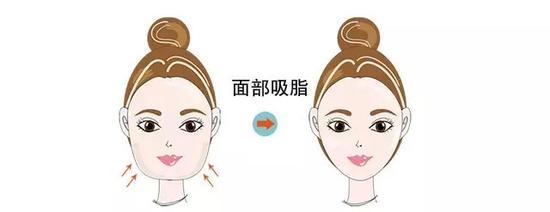 面部脂肪肥厚型