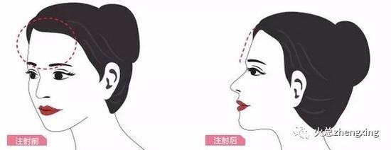 玻尿酸丰额头