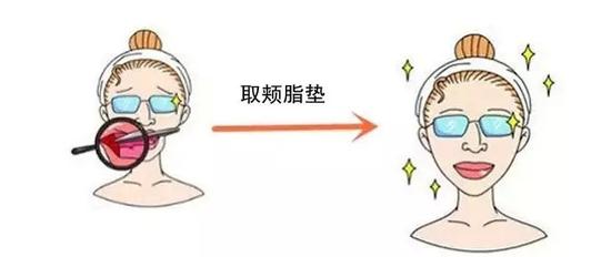 颊脂垫肥大型