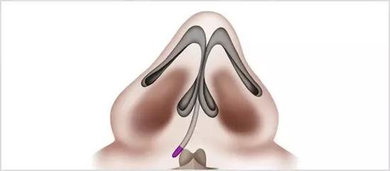 鼻中隔弯曲了还能做鼻综合手术吗?