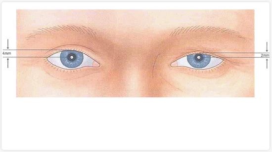 眼睑下垂的原因有哪些 ?(专业篇)|上睑下垂|重症