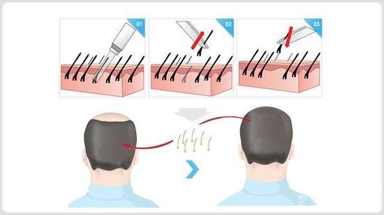 植发过程