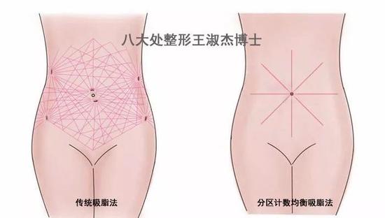 腰腹吸脂