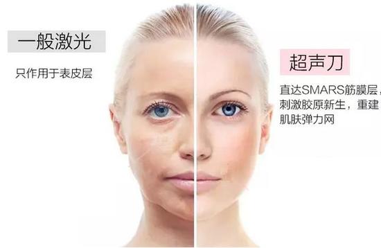 超声刀