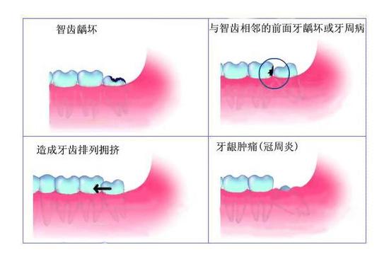 拔了智齿脸型会变吗?|智齿|瘦脸|拔牙