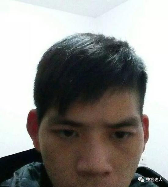 想要少女脸怎能容忍面部凹陷|双眼皮手术|凹陷