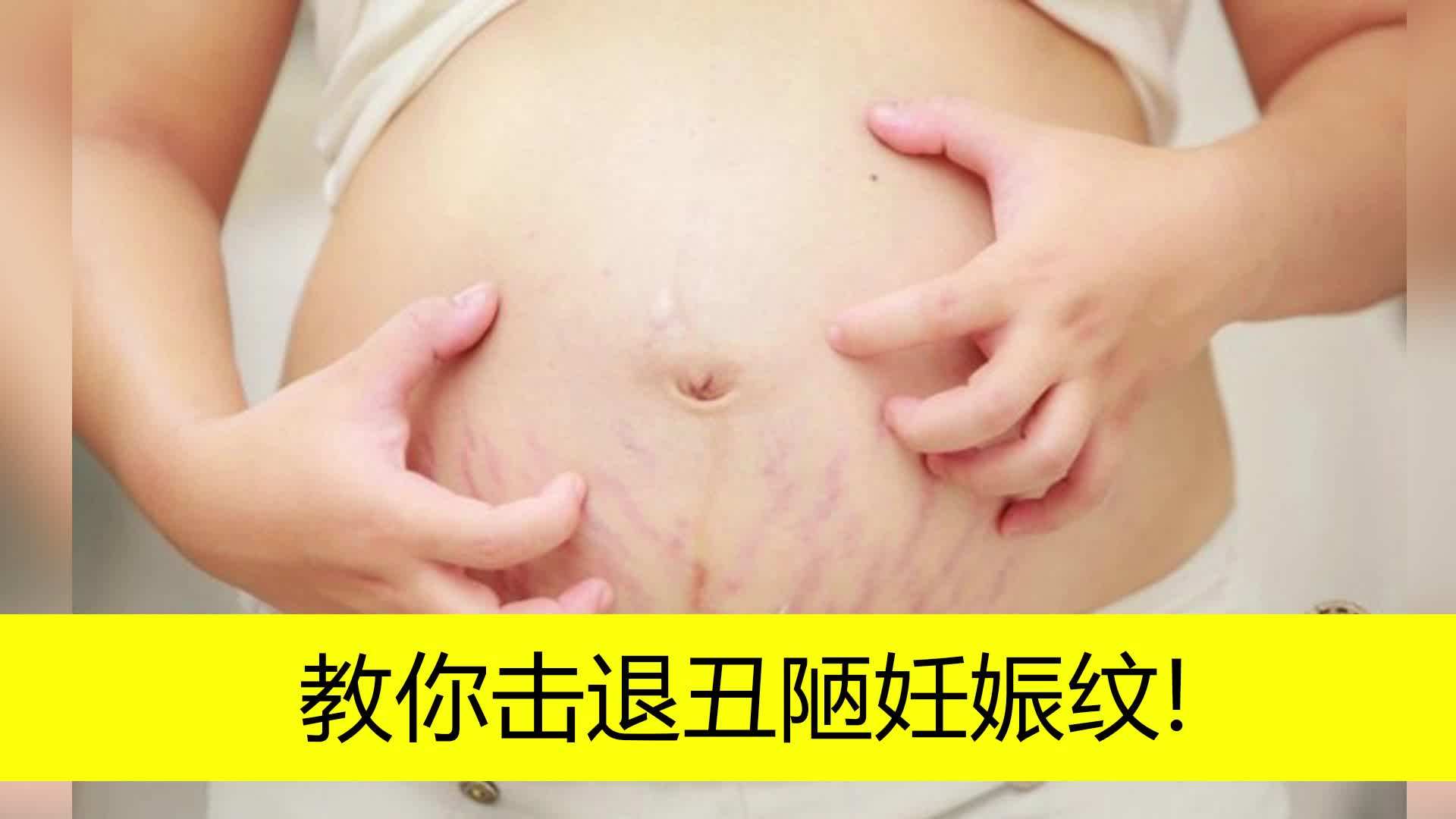 妊娠纹