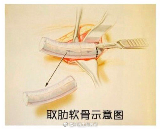 肋软骨