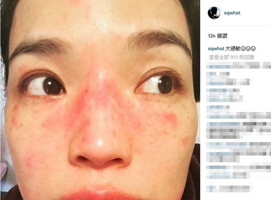 50天的婴儿脸和耳朵上长了疹子，这是湿疹吗，用什么药，医院最近感冒发烧的人多怕小孩被传染不敢去医院？