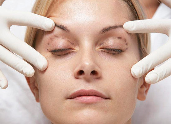 祛眼袋会留疤 或受4个因素影响|眼袋|女士|疤痕