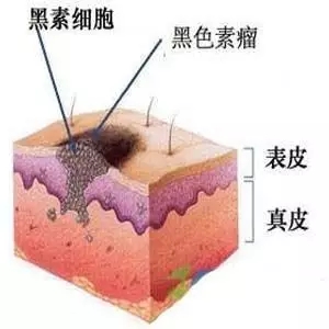 虽然表面看上去也是一个小黑点，但黑素瘤可比普通的痣凶险多了……