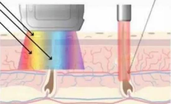祛斑、嫩肤、提亮…都说光子嫩肤好,副作用你