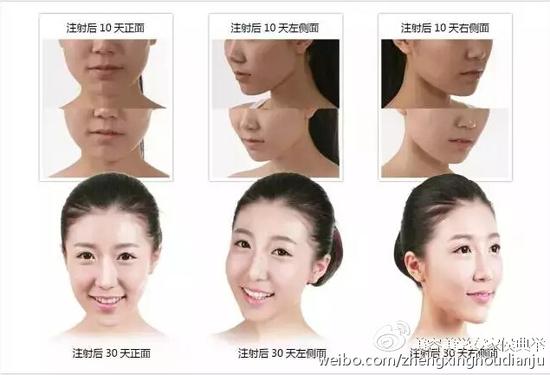 脸瘦