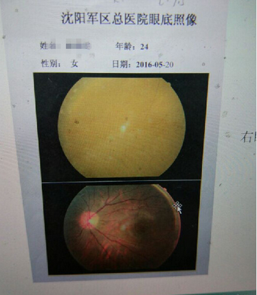 小晴的眼底图像,明显被玻尿酸覆盖